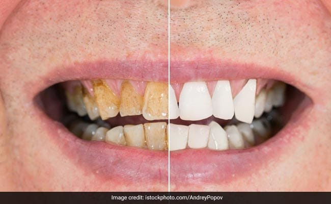 sdm6fdf_yellow-teeth-home-remedies_625x300_07_July_22 (1).jpg