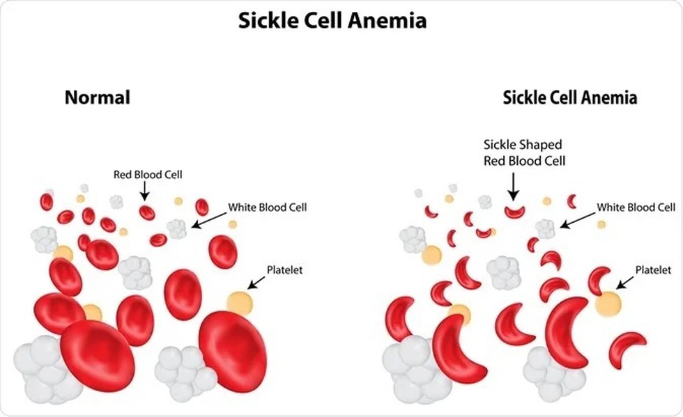 World Sickle Cell Day  3.jpg